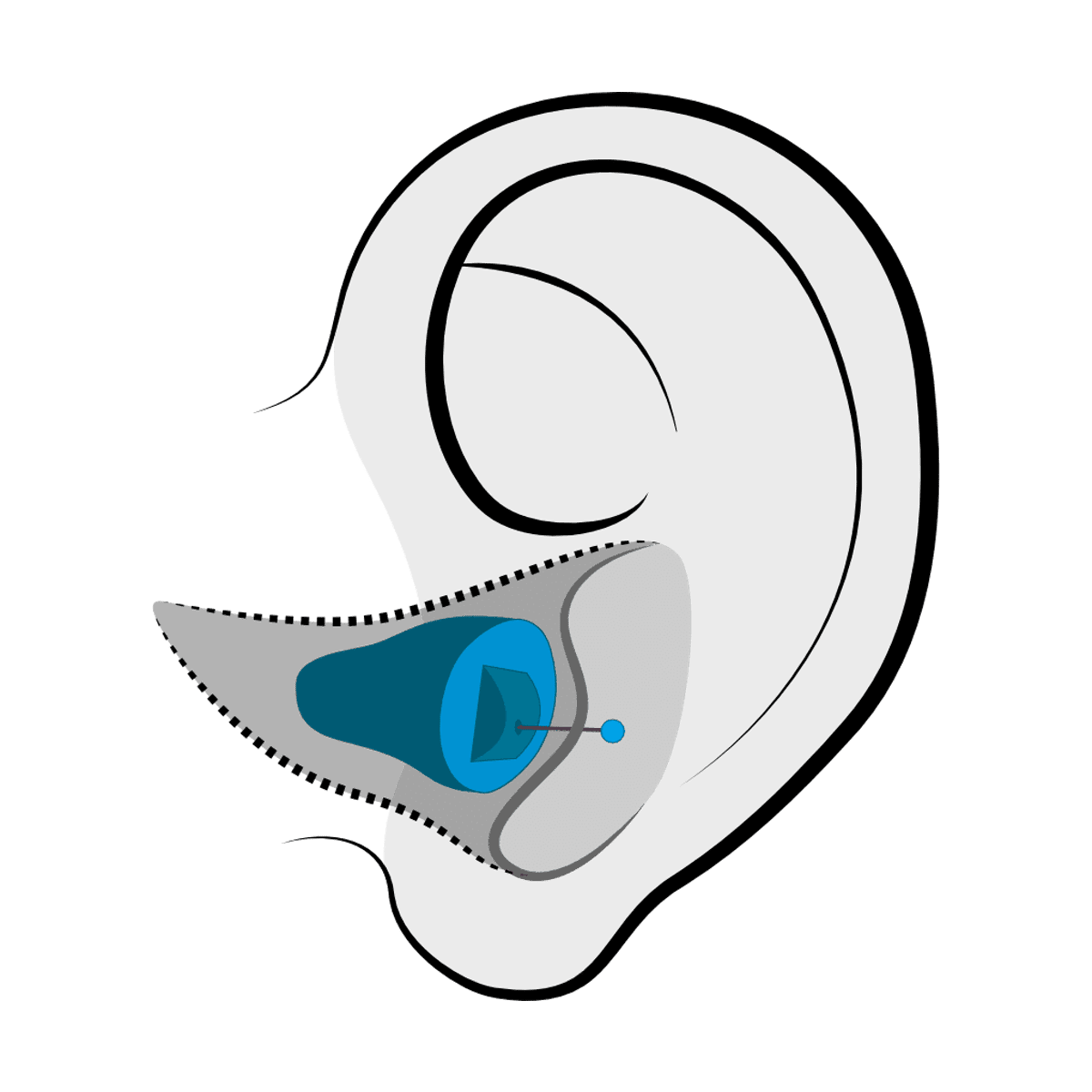 Invisible-in-Canal (IIC) hearing aid style discussed at Optimum Audiology in Apple Valley, CA